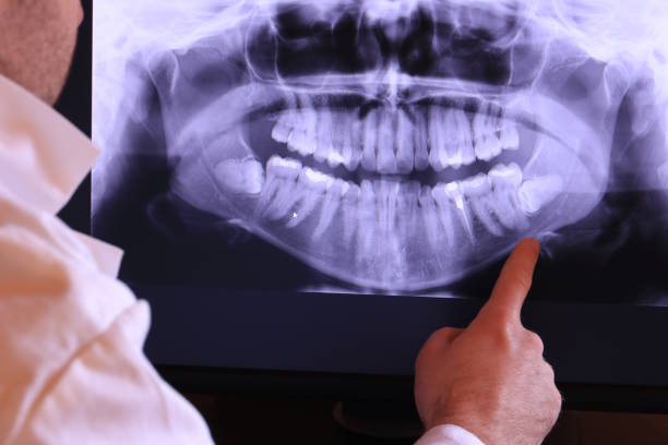 Best Emergency Wisdom Teeth Removal in Crompond, NY
